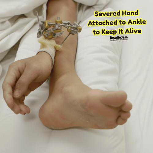 A severed hand attached to the leg to keep it alive temporarily